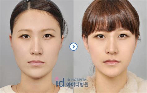 Id Hospital Korea Best Doctor For Mini V Line Surgery In Korea