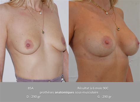 Clinique Del Mar Augmentation Mammaire