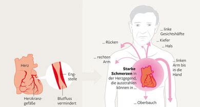 Was Ist Eine Koronare Herzkrankheit Khk Apotheken Umschau