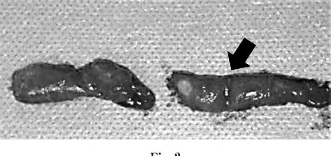 Figure 2 From A Case Of Axillofemoral Bypass Graft Stump Syndrome Occurring In Both The Upper