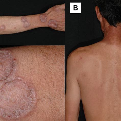 A Multiple Annular Plaques On The Upper Limbs B Multiple Annular