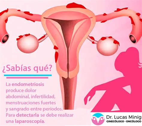 Qué es la endometriosis Síntomas y tratamientos Dr Lucas Minig