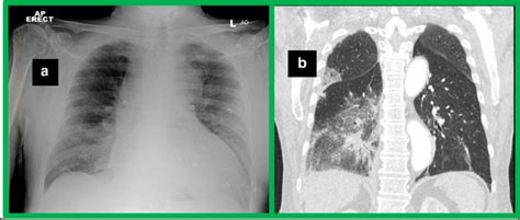 A Ap Chest Radiograph Demonstrates Airspace Opacification In The Right