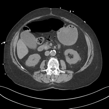 Acute cholangitis | Radiology Reference Article | Radiopaedia.org