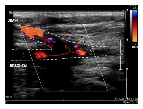 Duplex Doppler Ultrasound Of The Left Antecubital Fossa Demonstrating A Download Scientific