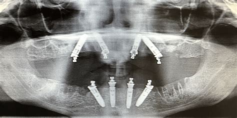 Dental Implant Procedure How Long Does It Take