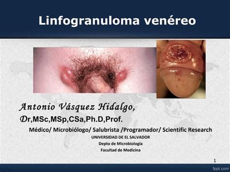 Que Es El Linfogranuloma Venereo Y Como Se Contagia Esta Enfermedad De