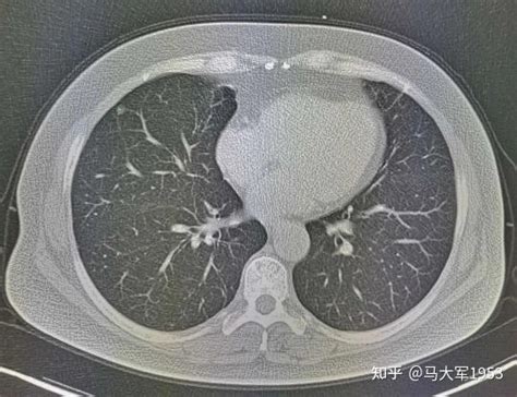 肺结节复查应该注意什么？复查方法有哪些？ 知乎