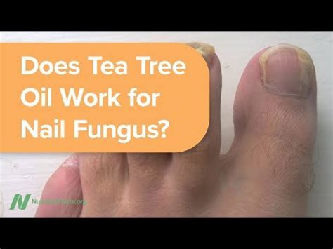 How to Dilute Tea Tree Oil for Toenail Fungus - Healthy Huemans