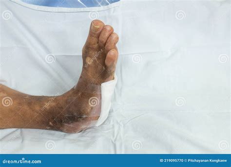 Infected Wound Of Diabetic Foot Stock Photo Image Of Damage Disease