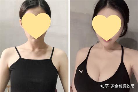 【自体脂肪隆胸最全攻略】什么是脂肪隆胸？和假体隆胸相比有什么优势？附全国30 城市隆胸医生名单！ 知乎