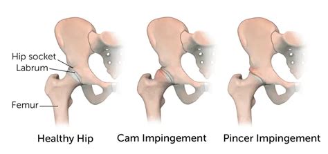 Hip Impingement Orchard Health Clinic Osteopathy Physiotherapy And