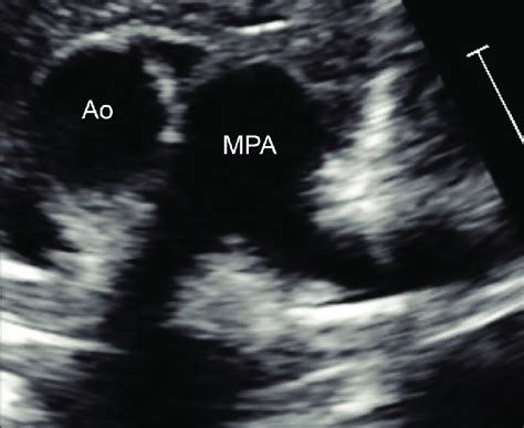 Transthoracic Echocardiogram Parasternal View Showing Complete