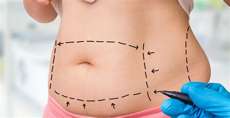 Como Fazer Inscri O Abdominoplastia Pelo Sus Pl Stica Para Todos