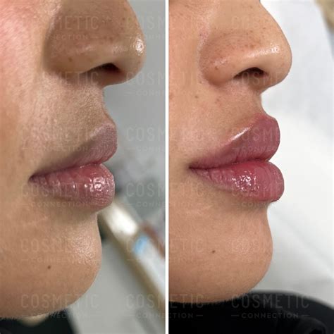 Understanding Lip Filler Dissipation Cosmetic Connection