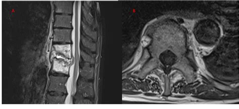 Figure From A Rare Case Of Vertebral Osteomyelitis With Associated