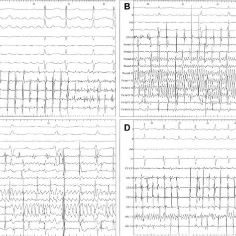 A Intracardiac Electrograms Demonstrating A Regular Atrial Tachycardia Download Scientific