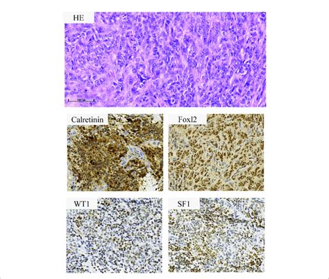 Histopathological Features Of The Ovarian Granulosa Cell Tumor The