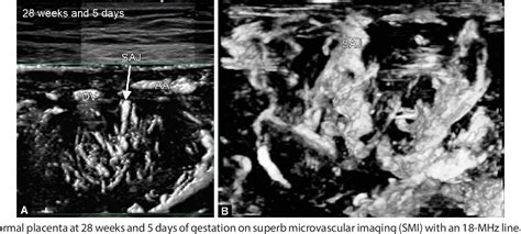 Figure From Superb Microvascular Imaging Assessment Of Placenta Using