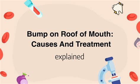 Bump On Roof Of Mouth 16 Possible Causes - vrogue.co