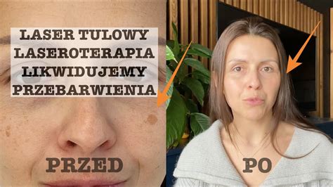 Laser Tulowy Redukcja Przebarwie Przed I Po Youtube