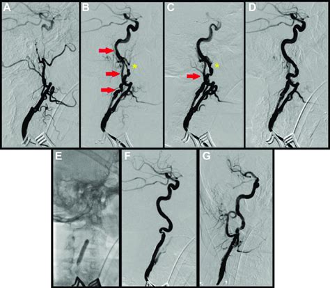 Rescue procedure. A, Initial angiogram demonstrating carotid artery ...