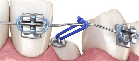 La Fenestraci N De Caninos En Ortodoncia Cl Nica Dental Carlos Gavira