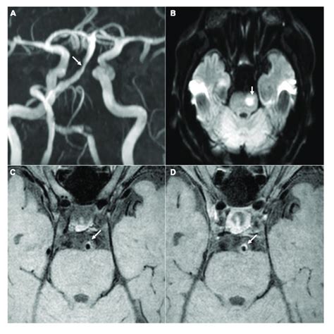 A Representative Case Of Acute Ischemia In Vertebrobasilar