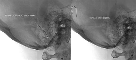 Case Archives Venous Pulsatile Tinnitus