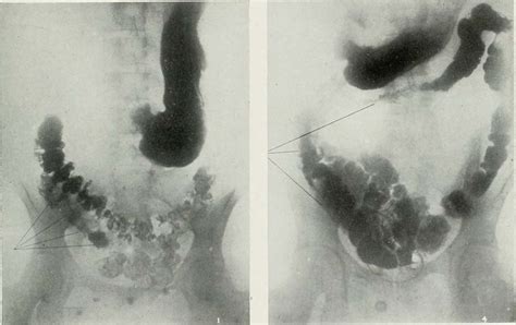 Spastic colon treatment | General center | SteadyHealth.com