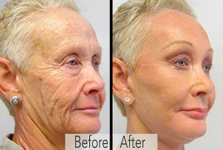 Better Than Botox Cream Removes Eye Bags In 90 Seconds Guardian