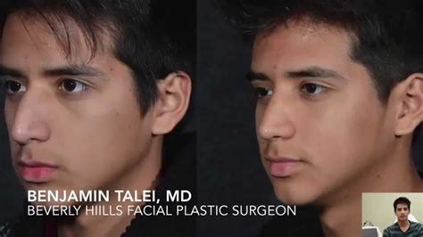 Beverly Hills Minimally Invasive Rhinoplasty Nose Surgeon Closed