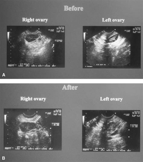 Transvaginal Ovarian Drilling A New Surgical Treatment For Improving