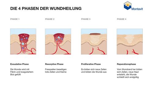 Wundheilung Beschleunigen Phasen Der Wundheilung Montavit