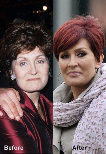 Sharon Osbourne Facelift Celebrity Face Lift Before And After