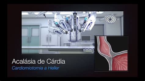 Cardiomiotomia A Heller