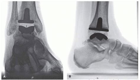 Aseptic Loosening Musculoskeletal Key