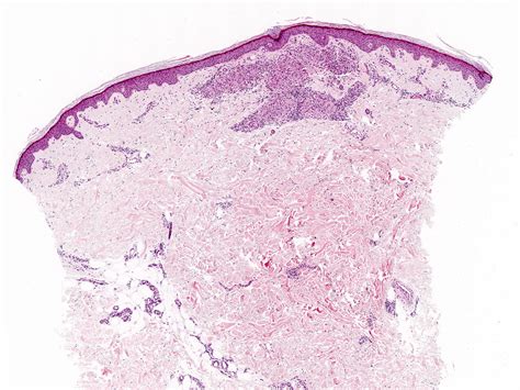 Lupus Pernio Histology