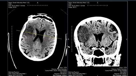 Stroke Imaging Fellowship Certificate Mri Online Is Now Medality