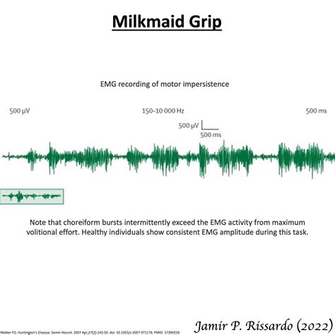 Milkmaids Grip Motor Impersistence Of The Hand” Philippus Aureolus