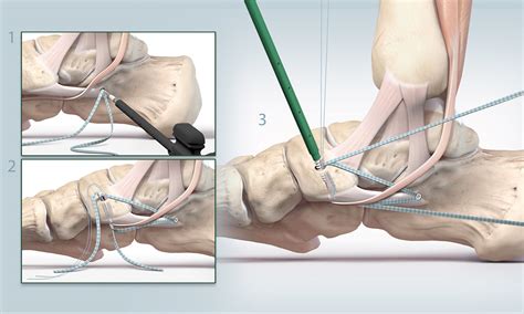 Eckhold Biomedical Illustration - ATFL LIGAMENT REPAIR