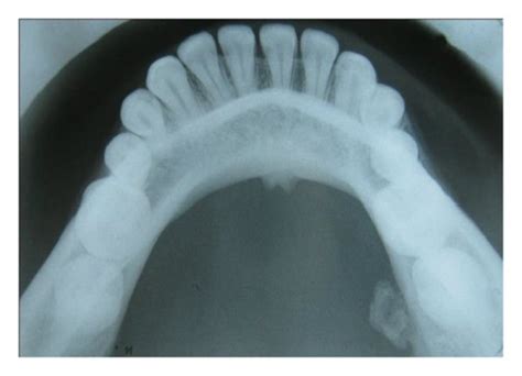 Mandibular Occlusal Cross Sectional Radiograph Download Scientific Diagram