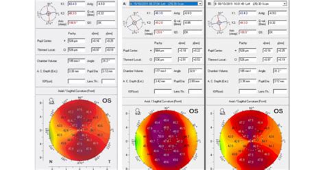 Crstg Europe Edition High Astigmatism And Amblyopia