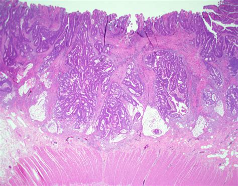 Case Of The Month Numerous Colonic Polyps University Of Rochester