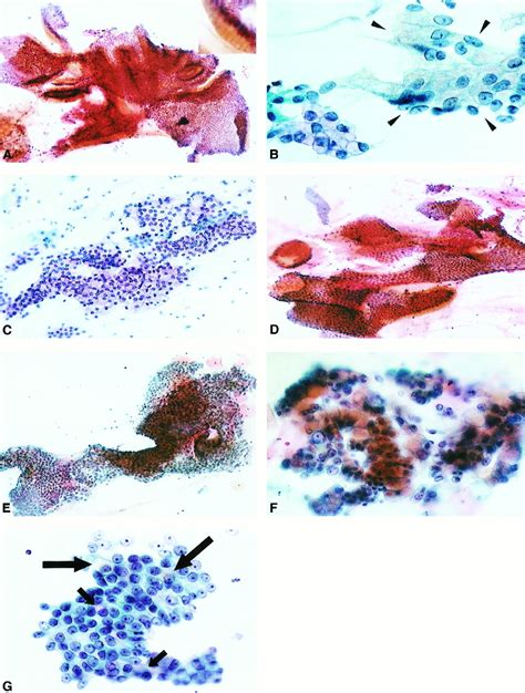 Cytologic And Cytochemical Features Of Adenoma Malignum Of The Uterine