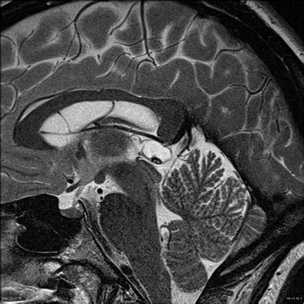 Pineal Gland Sagittal Mri