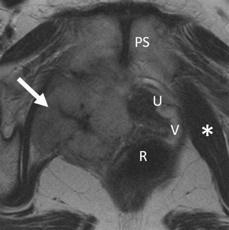 Imaging Of The Vagina Spectrum Of Disease With Emphasis On MRI