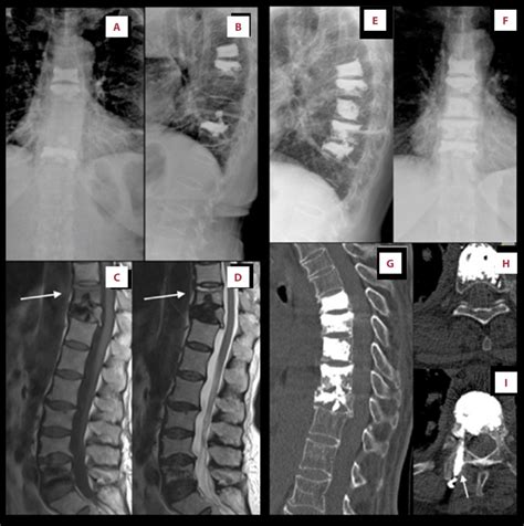 Thoracolumbar Radiography In Anteroposterior And Lateral Views A B