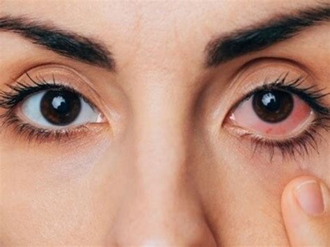 Monsoon Eye Flu Alert Know Why Conjunctivitis Cases Increase In Monsoon