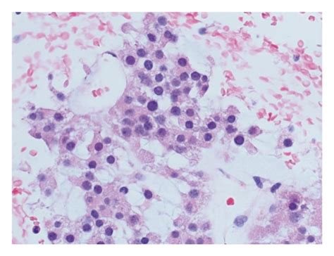 Photomicrograph of liver mass biopsy of Patient B. (a) Tumor cells with ...